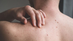 The suns out so you need to think about prevention of this type of cancer  CNN The suns out so you need to think about prevention of this type of cancer  CNN