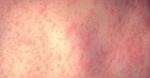 Philadelphia Warns Of Measles Outbreak After Quarantined Kid Sent To Day Care Anyway  HuffPost