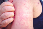 Multiple measles outbreaks prompt CDC alert  WJW FOX 8 News Cleveland Multiple measles outbreaks prompt CDC alert  WJW FOX 8 News Cleveland