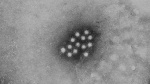 Possible Hepatitis A Exposure at 2 Westbrook Restaurants  WMTW Portland Possible Hepatitis A Exposure at 2 Westbrook Restaurants  WMTW Portland