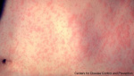 Second measles case reported in Michigan  WOODTVcom Second measles case reported in Michigan  WOODTVcom