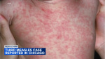 Measles outbreak Chicago 2nd child at Pilsen migrant shelter diagnosed in citys 3rd case CDC to send response team CDPH says  WLSTV Measles outbreak Chicago 2nd child at Pilsen migrant shelter diagnosed in citys 3rd case CDC to send response team CDPH says  WLSTV