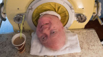 Polio Paul who spent most of the past 70 years in an iron lung dies at 78 CNN Polio Paul who spent most of the past 70 years in an iron lung dies at 78 CNN
