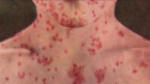 Possible measles exposure at East Bay restaurant  KTVU FOX 2 San Francisco