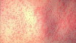 Long Island measles case in unvaccinated child confirmed by Nassau County Department of Health  WABCTV Long Island measles case in unvaccinated child confirmed by Nassau County Department of Health  WABCTV