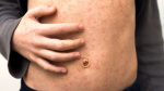 US measles elimination status threatened due to 2024 outbreak CDC report  ABC News US measles elimination status threatened due to 2024 outbreak CDC report  ABC News