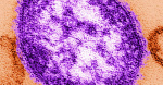 Measles case confirmed in Dane County  News  channel3000com  Channel3000com  WISCTV3 Measles case confirmed in Dane County  News  channel3000com  Channel3000com  WISCTV3